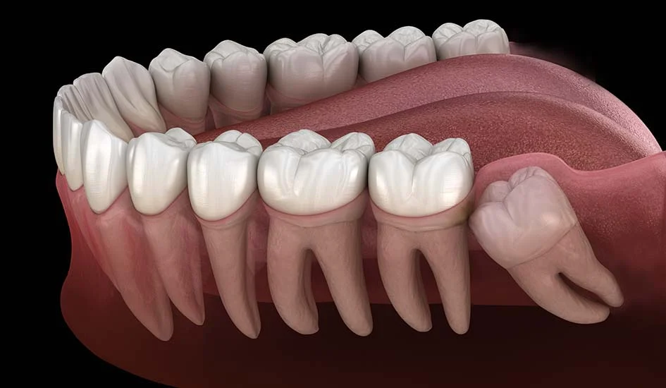 Impacted Wisdom Tooth Anatomy